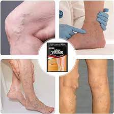 Super Oferta VaricEase Pro Reduce la Hinchazón y el Dolor